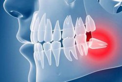 Как происходит удаление зуба мудрости в условиях современной стоматологии